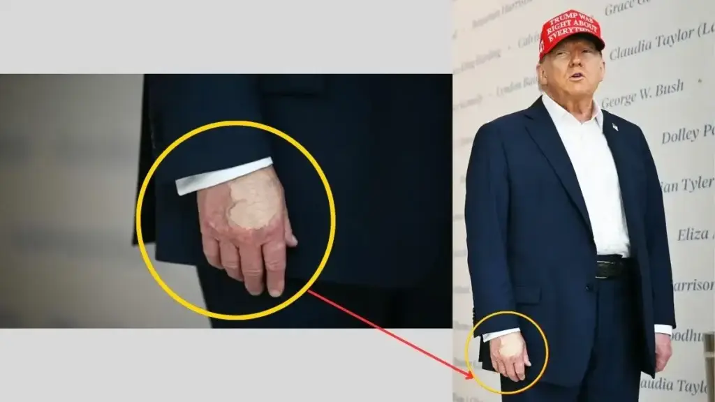 Close-up of Donald Trump's hand with visible makeup patch, highlighting recent Trump's health concern, during a public event in a blue suit.