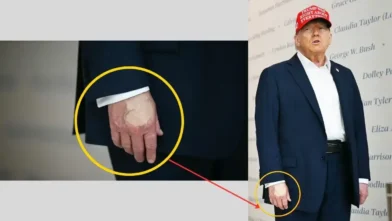 Trump’s Health Concern : Hand Makeup Raises Questions, Why?